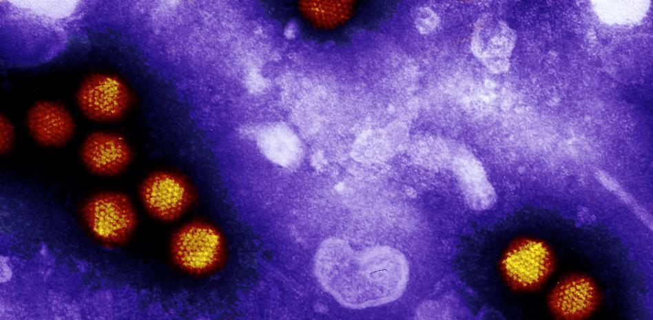 hepatitis